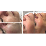 Dermaplaning