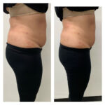 Lipofirm Pro Body Treatments