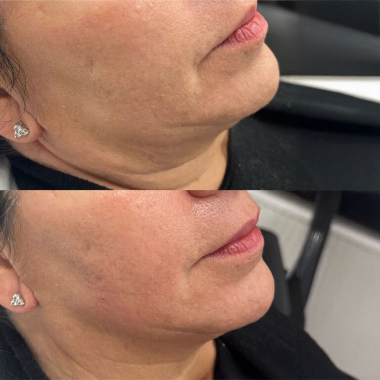 A side by side comparison of a woman's chin before and after having Lemon Bottle Fat Dissolving Injections.