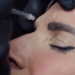 Anti-Wrinkle Injections - Image 2