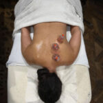 Cupping